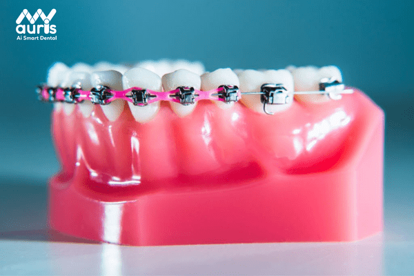 Tại sao niềng răng giá rẻ lại luôn được nhiều người ưu tiên?