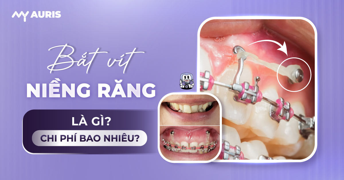 niềng răng bắt vít,vít niềng răng,niềng răng có cần bắt vít