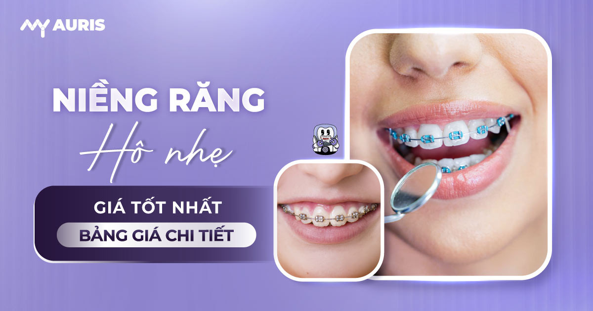 niềng răng hô nhẹ