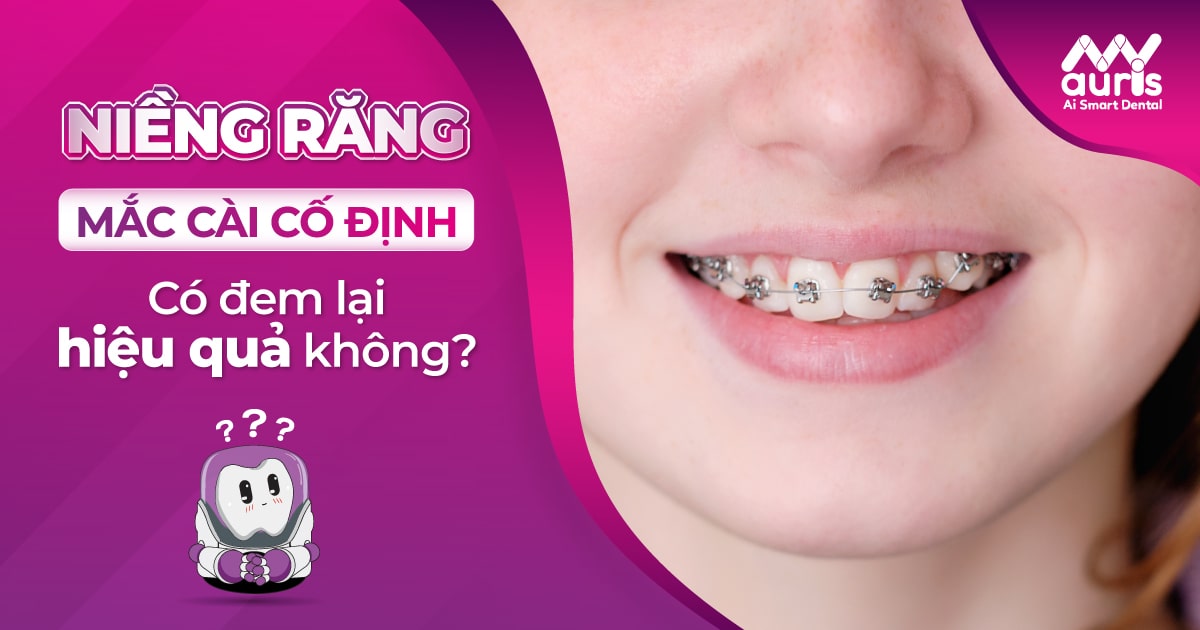 niềng răng mắc cài cố định