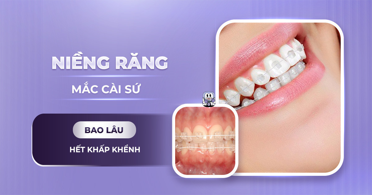 Niềng răng mắc cài sứ bao lâu