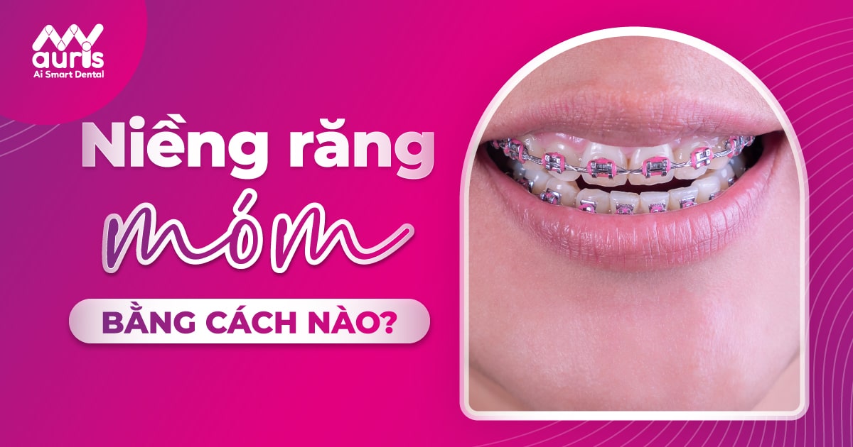 Niềng răng móm có hiệu quả không và bằng cách nào?