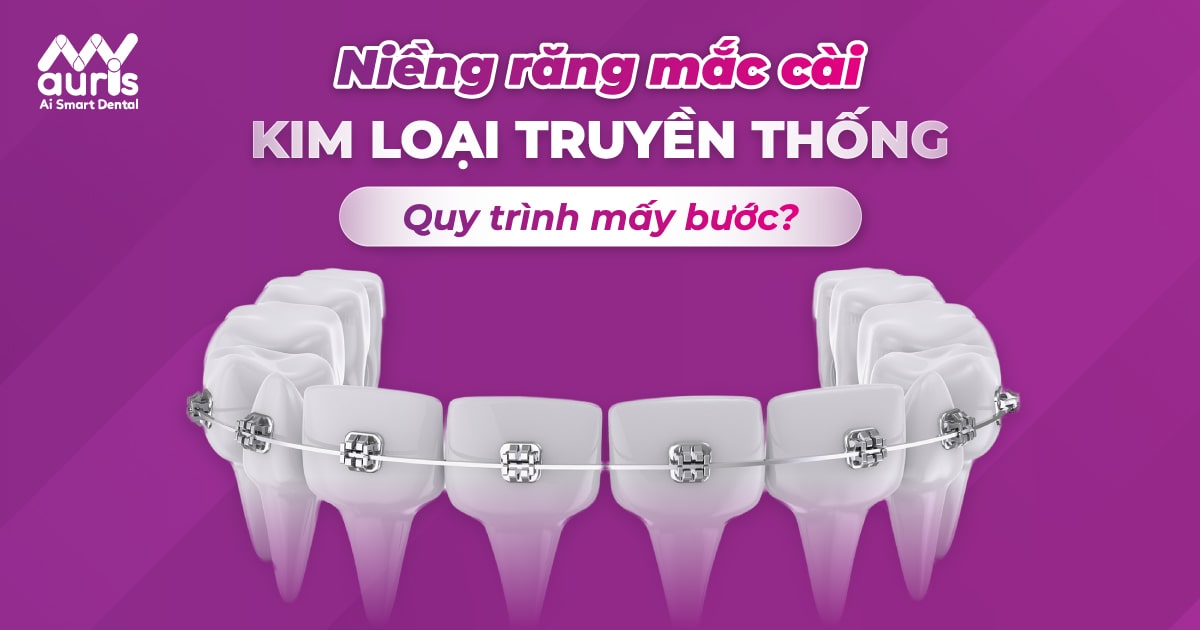 Có cần đến nha sĩ để tháo rời niềng răng mắc cài kim loại truyền thống?