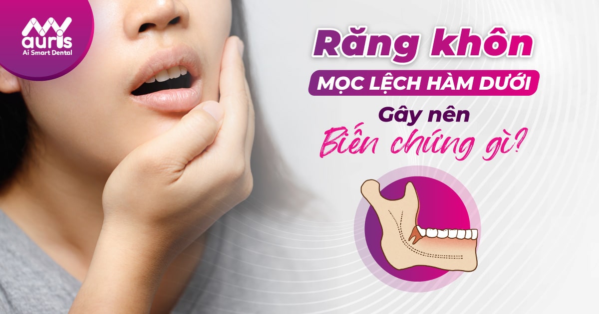 Răng khôn mọc lệch hàm dưới