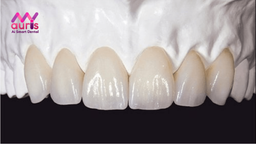 răng sứ zirconia có mấy loại