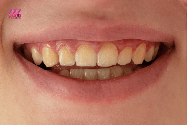 răng ố vàng có tẩy trắng được không