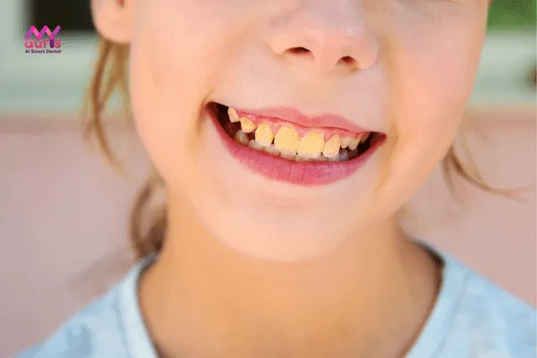 răng ố vàng có tẩy trắng được không