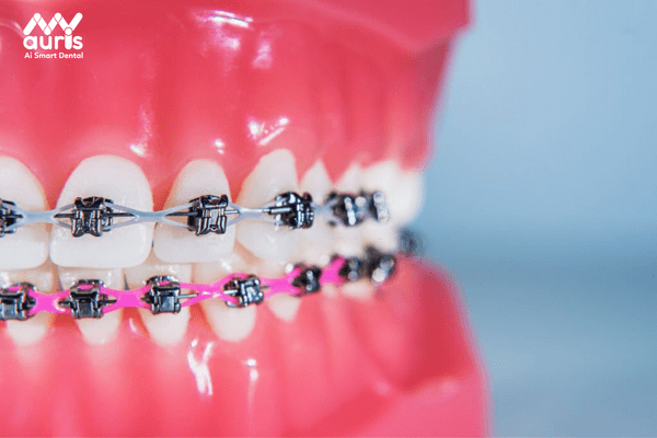 Tham khảo bảng giá niềng răng mắc cài kim loại tại nha khoa