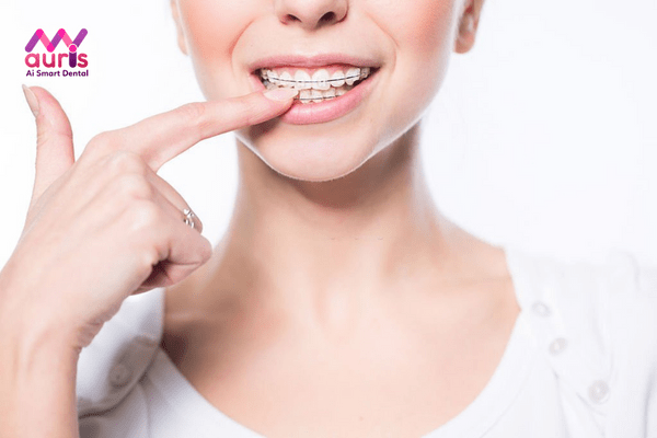 Các loại niềng răng mắc cài sứ có tốt không?