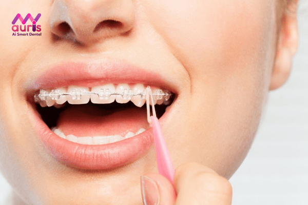 Niềng răng mắc cài sứ là kỹ thuật gì?