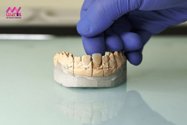 Ưu, nhược điểm của răng sứ kim loại thường