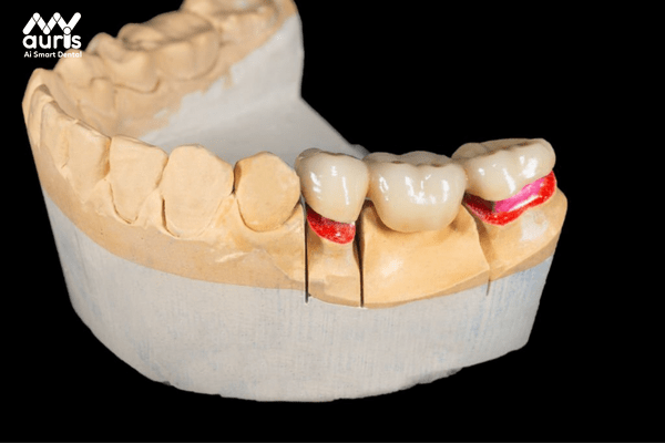 Tìm hiểu giá răng sứ kim loại thường là bao nhiêu? Chia sẻ của bác sĩ