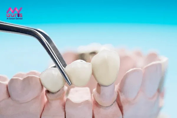 Chi phí trồng răng hàm dưới bằng cầu răng sứ