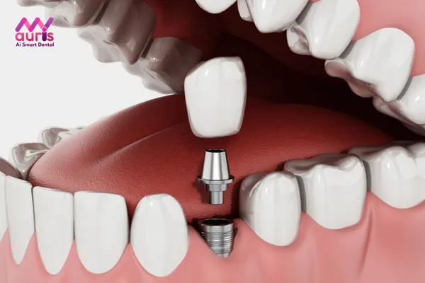 Trồng răng hàm dưới bao nhiêu tiền? - Cấy ghép Implant