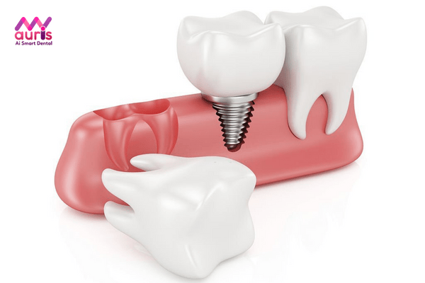 Nên trồng răng số 6 với phương pháp nào là tốt nhất?