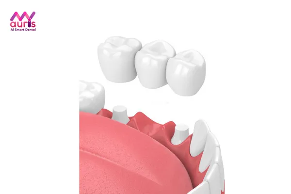 Trồng răng số 6 bằng cầu răng sứ