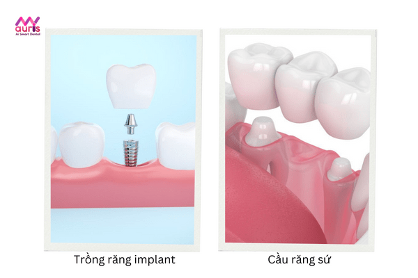 trồng răng sứ bao lâu