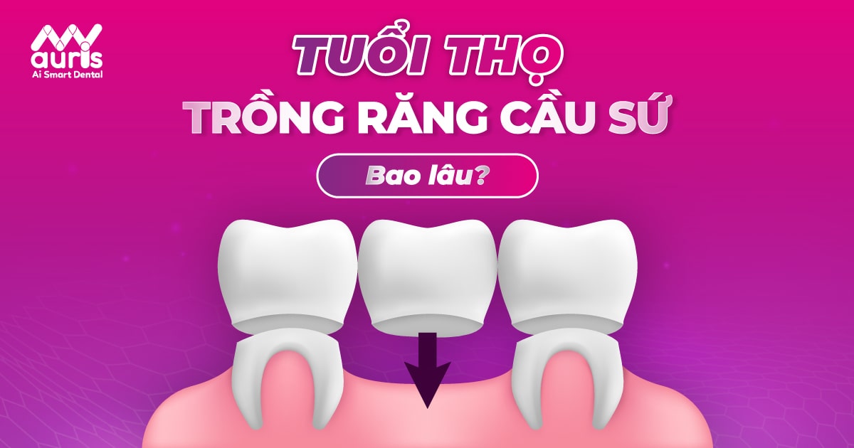 tuổi thọ trồng răng cầu sứ