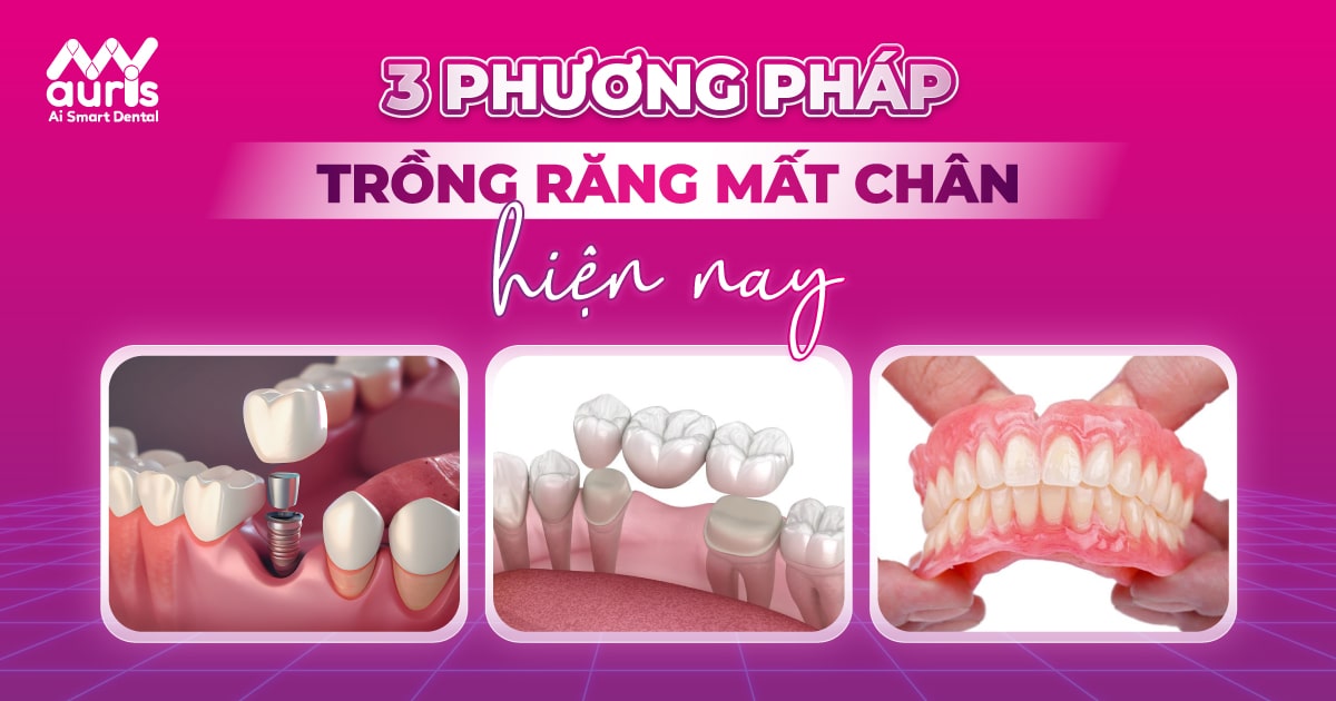 3 phương pháp trồng răng mất chân hiện nay