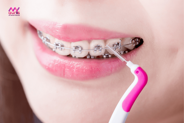 Trong toàn bộ quá trình niềng răng cần phải chăm sóc và vệ sinh răng miệng kỹ