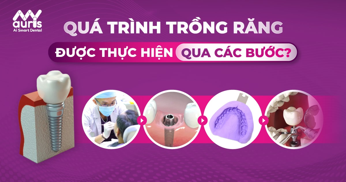 quá trình trồng răng