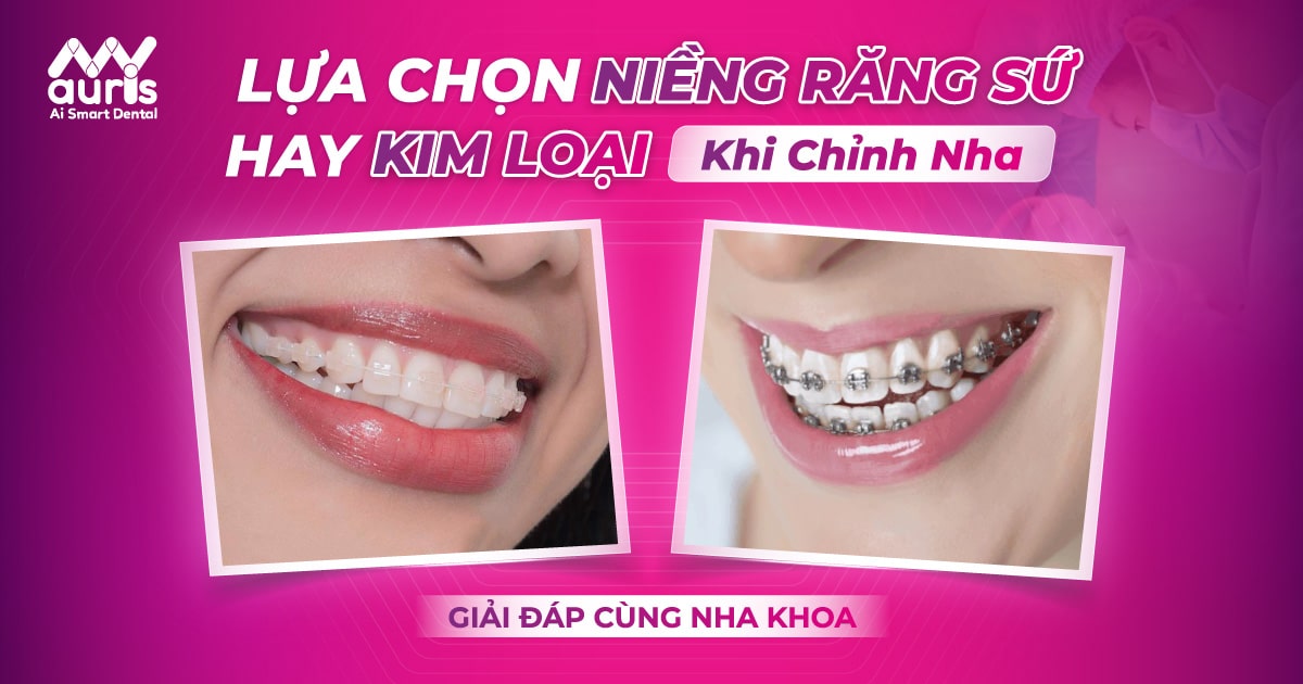 nên niềng răng sứ hay kim loại