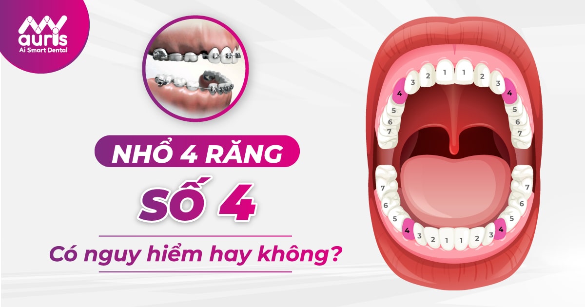 nhổ 4 răng số 4 niềng răng