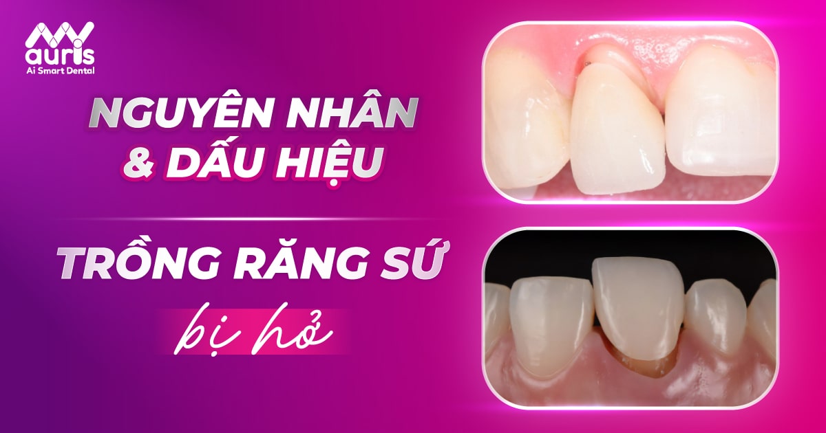 trồng răng sứ bị hở