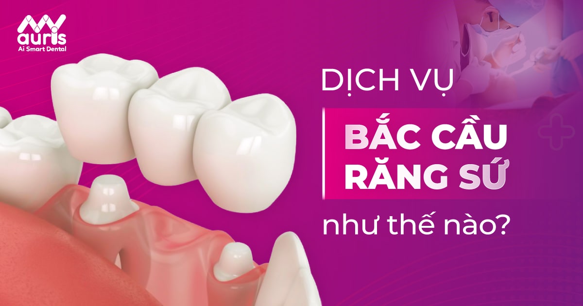 dịch vụ bắc cầu răng sứ