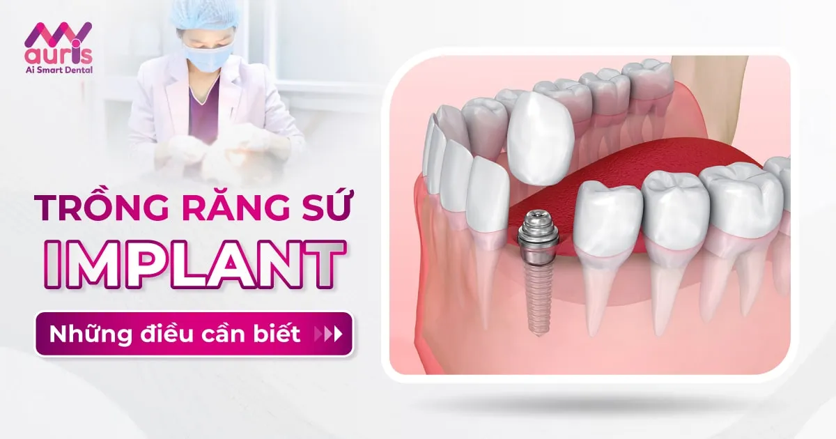 trồng răng sứ implant