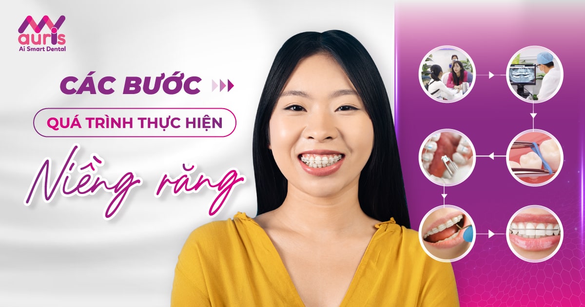 các bước trong quá trình niềng răng