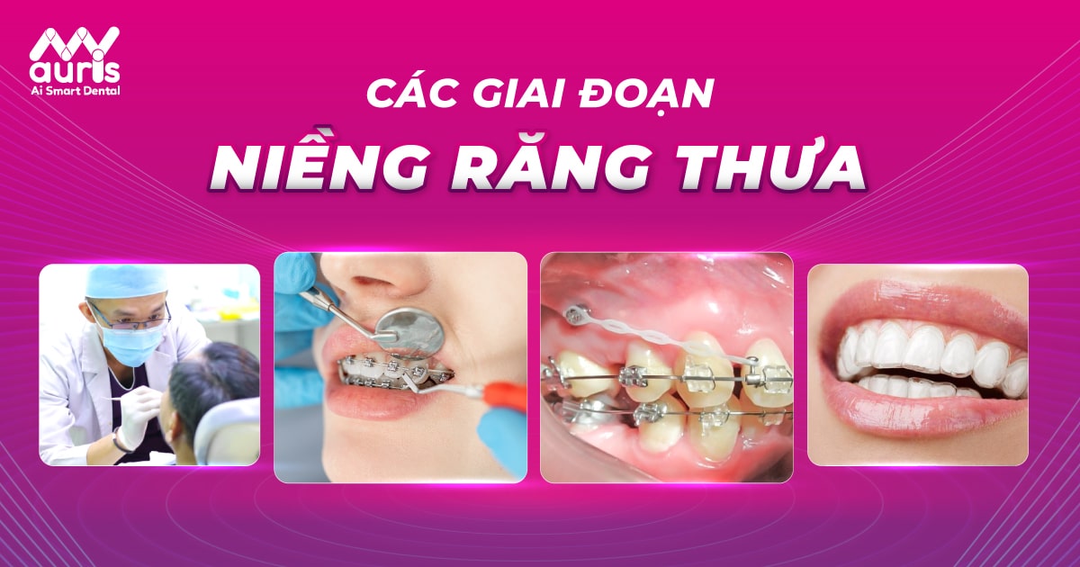 các giai đoạn niềng răng thưa