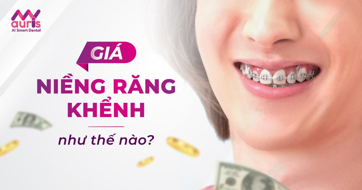 giá niềng răng khểnh