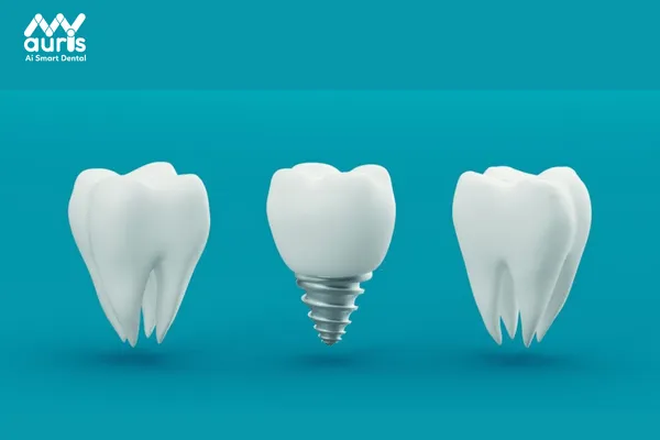 Trồng răng số 6 bằng Implant