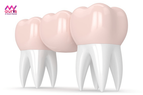 Răng sứ bắc cầu cho răng số 6