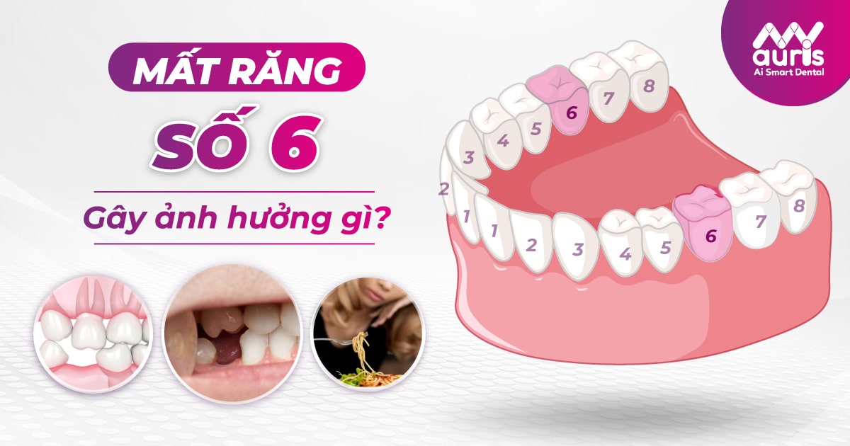 Mất răng số 6 có ảnh hưởng gì không? Bác sĩ giải đáp