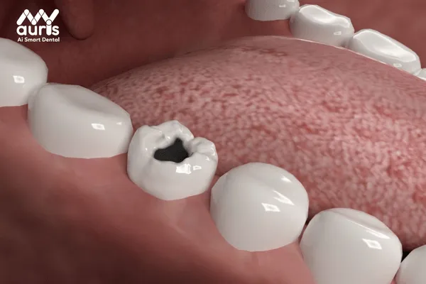 Bọc răng sứ cho răng hàm bị sâu là gì?