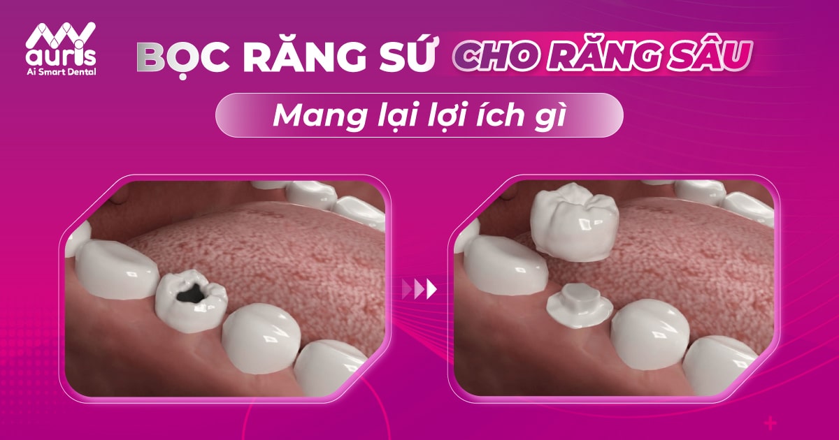 Bọc răng sứ cho răng hàm sâu mang lại lợi ích gì?