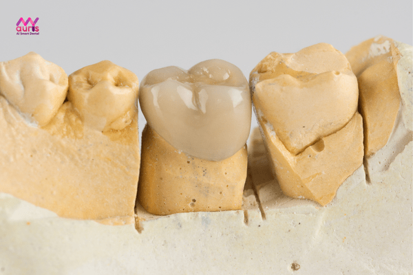 Lợi ích của bọc răng toàn sứ 