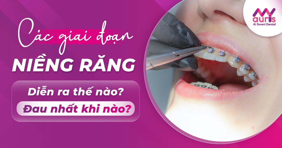 Các giai đoạn niềng răng