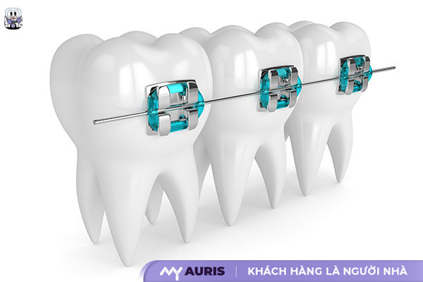 các khí cụ niềng răng