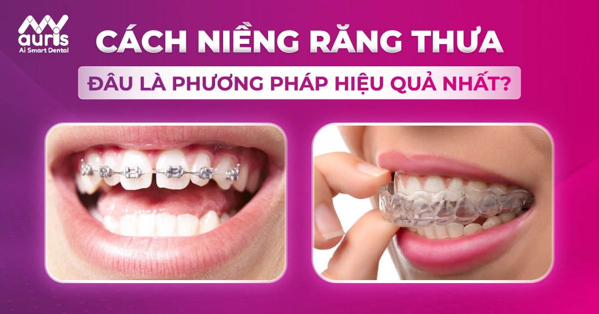 Cách niềng răng thưa