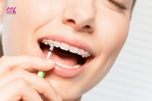 Khi niềng răng cần lưu ý vệ sinh răng miệng đúng cách