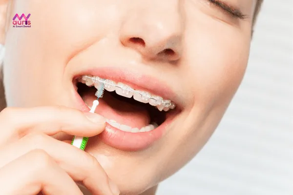 Khi niềng răng cần lưu ý vệ sinh răng miệng đúng cách