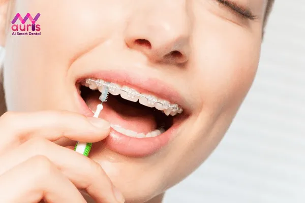 Có mấy loại chỉnh nha niềng răng mắc cài pha lê?