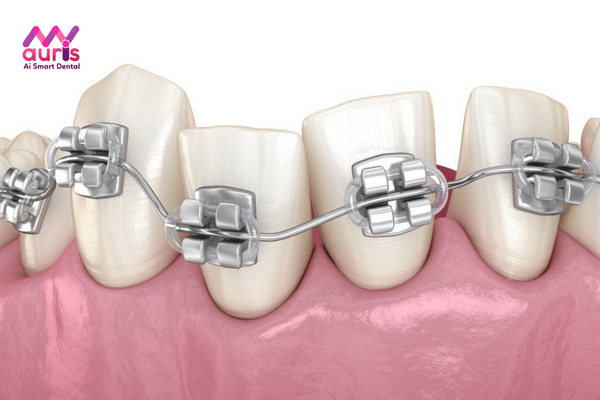 Điều trị răng khấp khểnh mất bao nhiêu thời gian?