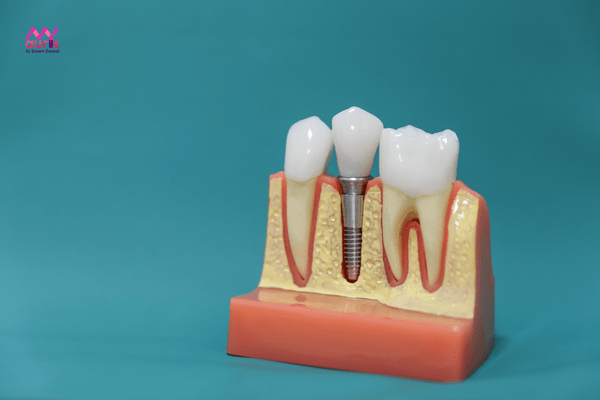 Tổng quan về răng implant hàn quốc