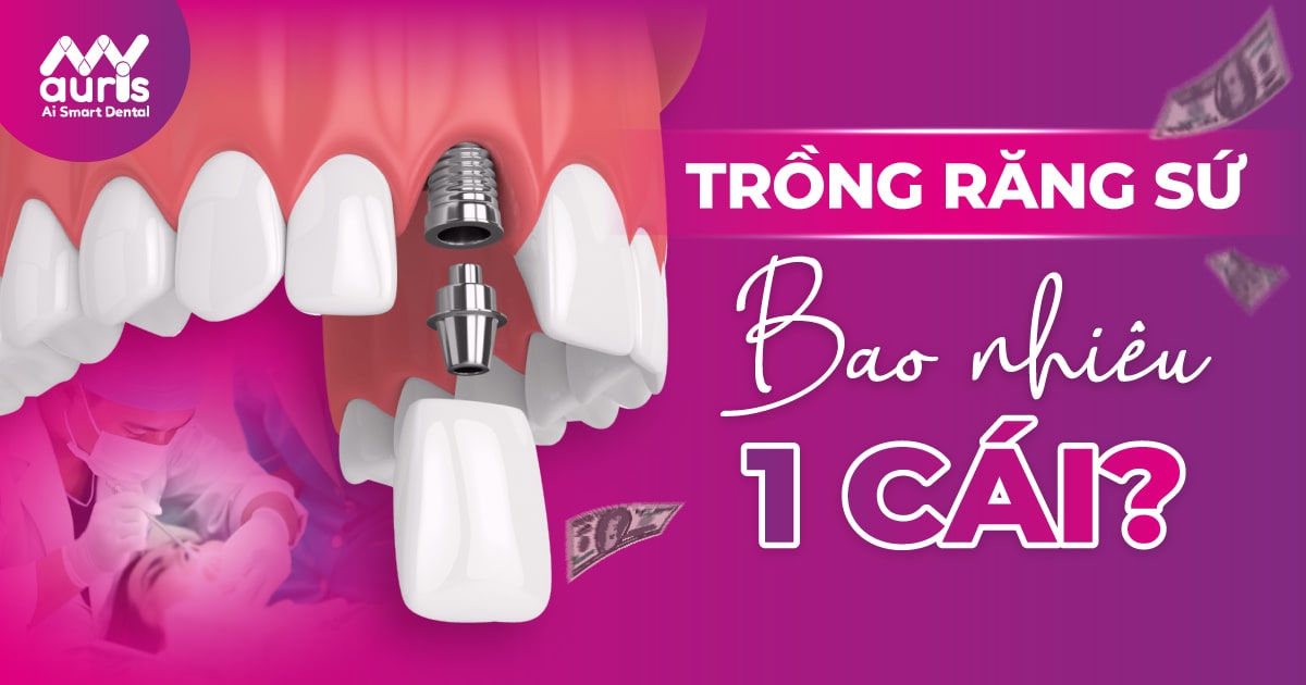 Trồng răng sứ bao nhiêu 1 cái?