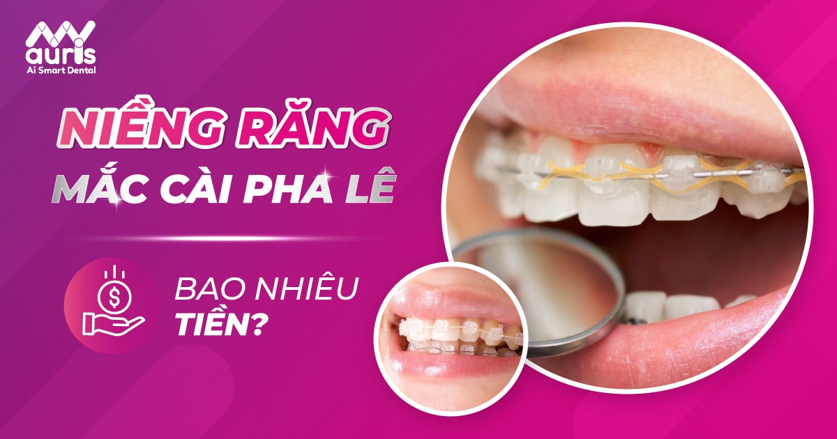 [Hỏi đáp] Niềng răng mắc cài pha lê bao nhiêu tiền?