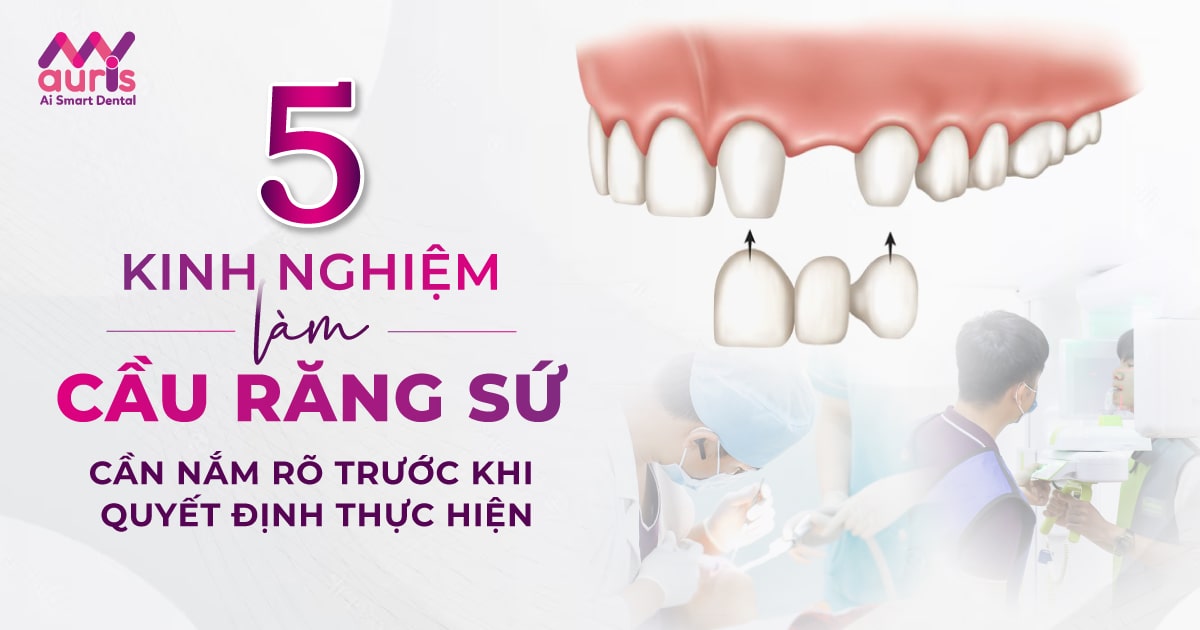 5 kinh nghiệm làm cầu răng sứ